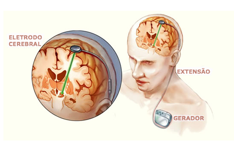 estimulo_cerebrais_epilepsia